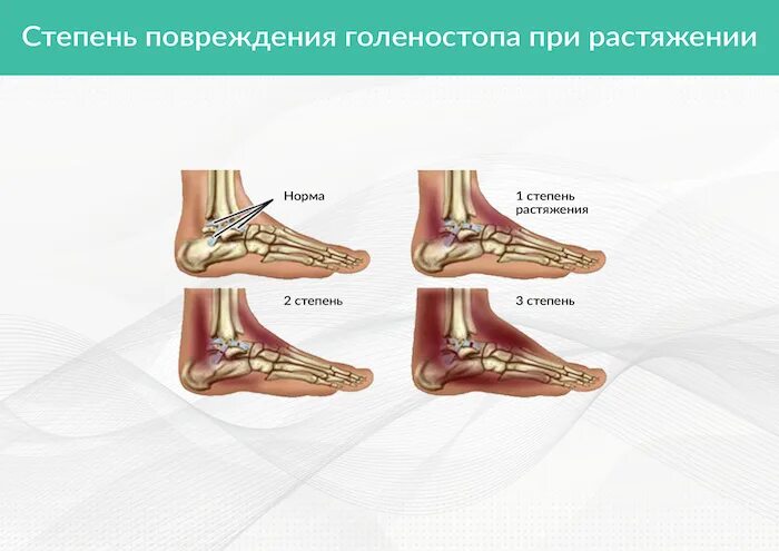 Заболевания голеностопа. Заболевания голеностопного сустава.