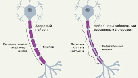Рассеянный склероз новое в лечении 2024