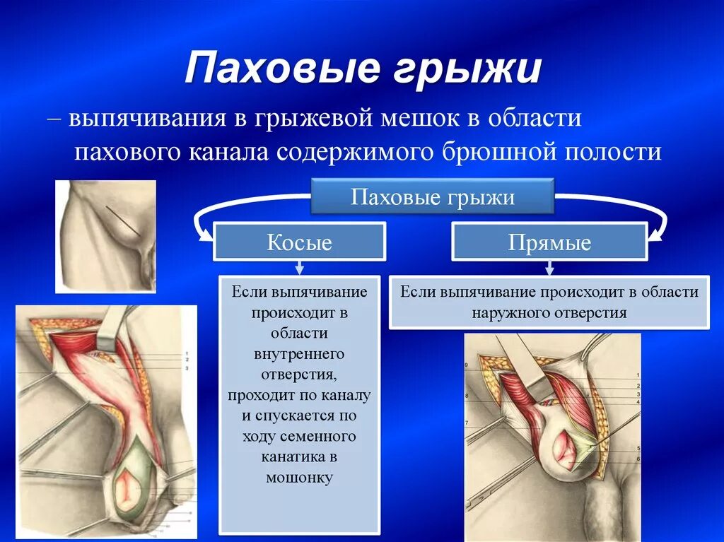 Паховая грыжа методы лечения. Грыжевой мешок паховой грыжи. Паховой мошоночной грыжи симптомы. Клиническая картина паховой грыжи. Паховая грыжа и семенной канатик.