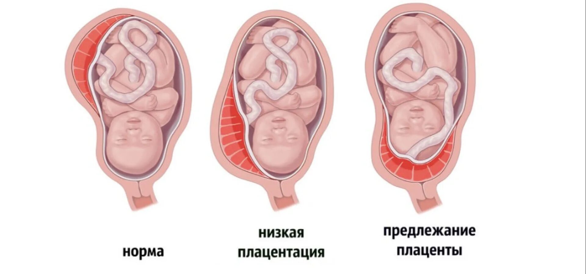 При низкой плацентации можно. Нормальное расположение плаценты. Типы предлежания плаценты. Нормальное предлежание плаценты. Нормальное расположение плаценты при беременности.