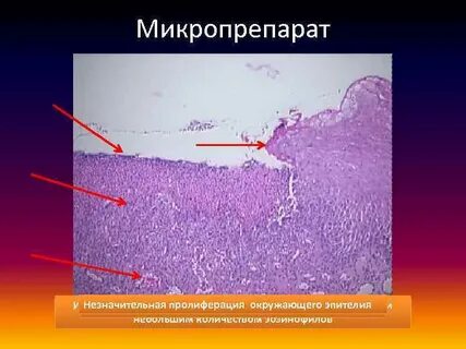 Пролиферация промежуточного эпителия