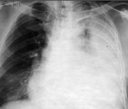 Левосторонний Тотальный гидроторакс. Тотальный гидроторакс рентген. Гидроторакс рентген туберкулез. Тотальное затемнение легкого со смещением средостения. Затемнение в левом легком
