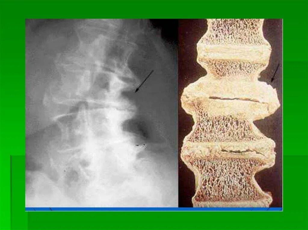 Остеофиты что это такое и как лечить. Спондилоартроз грудного отдела на рентгене. Остеофиты на рентгене шейного отдела. Спондилоартроз шейного отдела рентген. Деформирующий остеоартроз позвоночника.