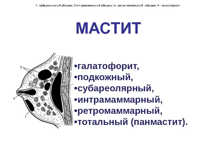 Маститы интрамаммарный. Интрамаммарный Гнойный мастит. Ретромаммарный мастит разрез. Мастит классификация хирургия. Острый гнойный мастит