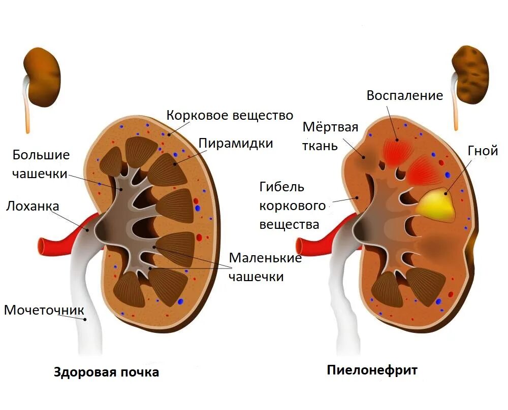 Болезнь почекпилонефрит. Болезнь почек пиелонефрит. Строение чашечно лоханочной системы почек. Патология почки. Пиелонефрит. Пневмония пиелонефрит