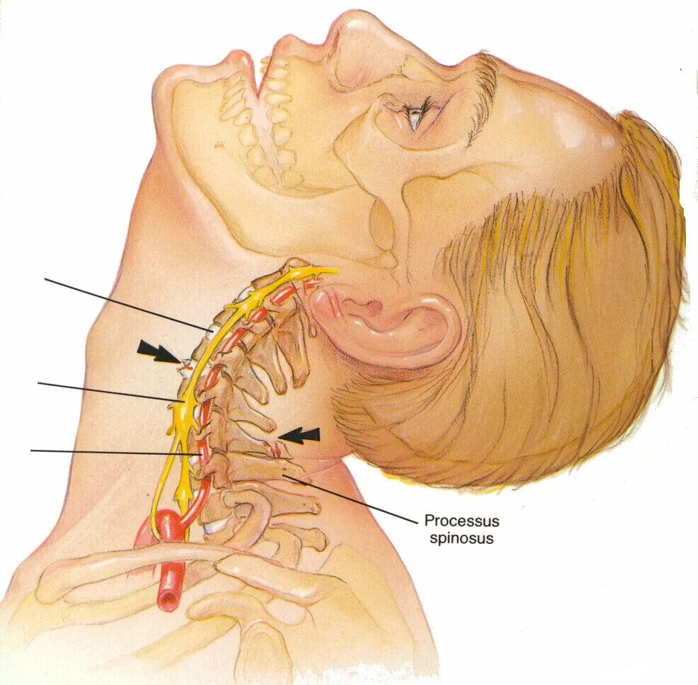 Защемило правую сторону шеи что делать. Остеохондроз шейного отдела позвоночника. Остеохондроз в шейном отделе. Позвоночник шея.