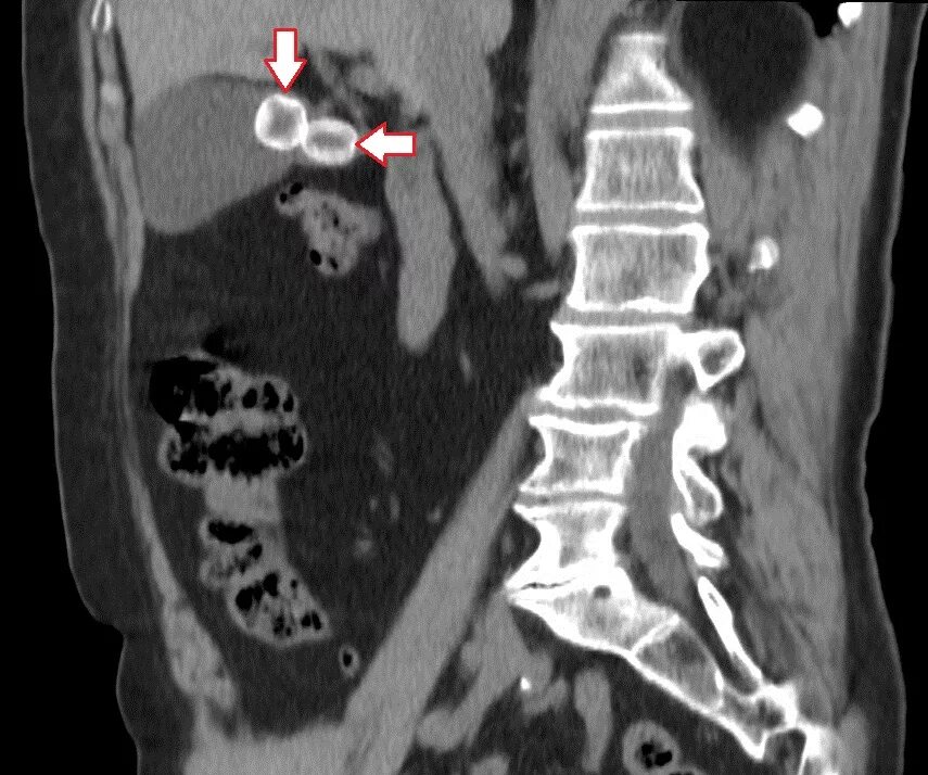 Камни на кт видны. Рентгенонегативные камни в желчном пузыре на кт. Конкременты желчного пузыря на кт. Кт брюшной полости желчный пузырь.