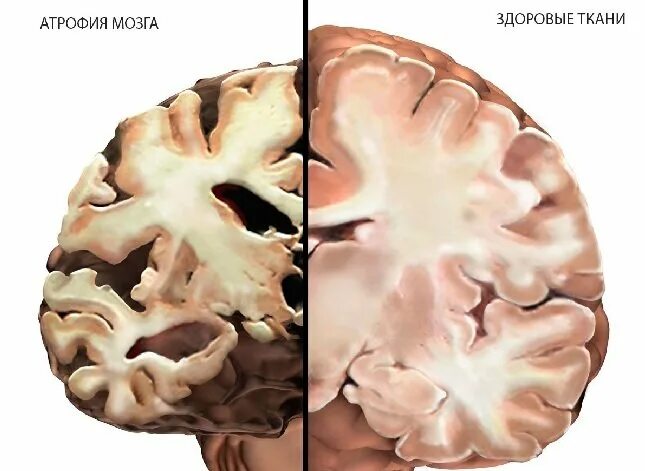 Отмирание клеток головного мозга. Мозг здоровый и Альцгеймера. Атрофические заболевания головного мозга. Атрофия головного мозга 1