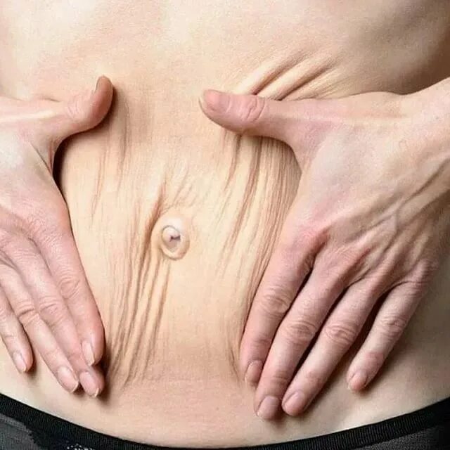 Дряблая кожа на животе как подтянуть