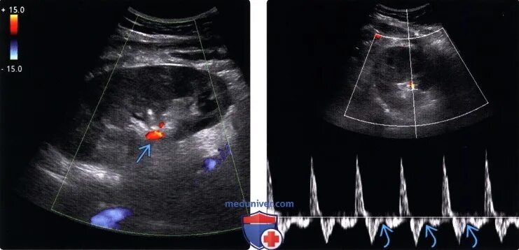 Допплерография сосудов почек. Опухолевый тромб в почечной Вене на УЗИ. Венозный застой почек УЗИ. Тромбоз почек