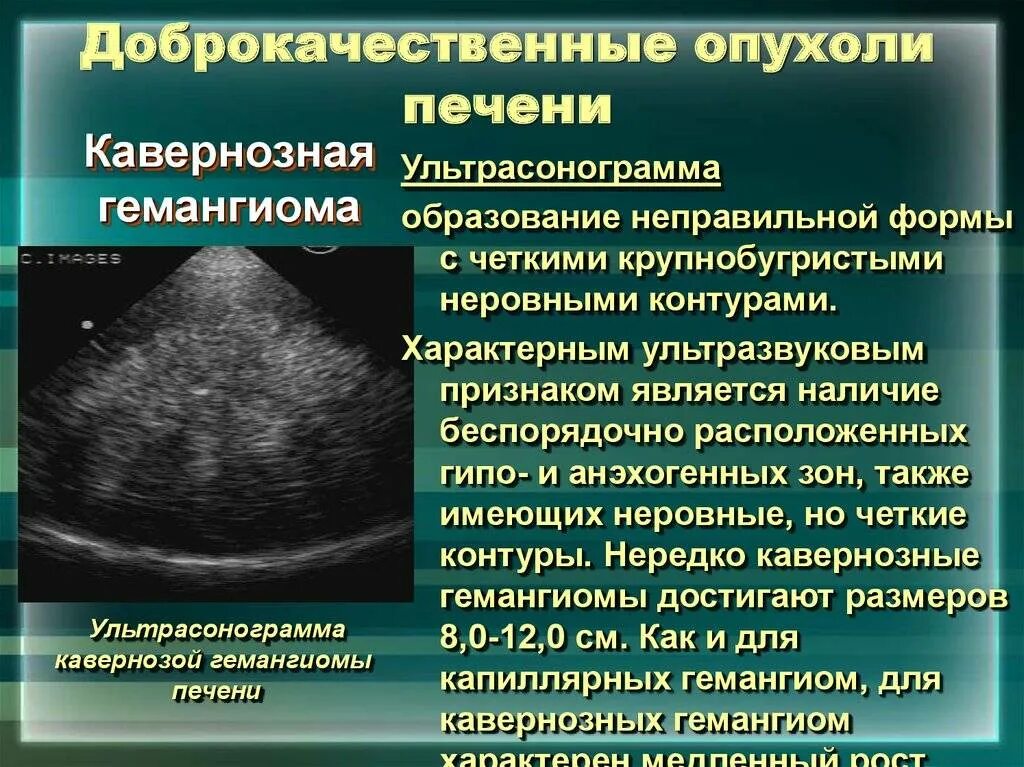 Новообразование в печени. Образования печени на УЗИ. Очаговое образование печени. Гемангиома печени причины и лечение