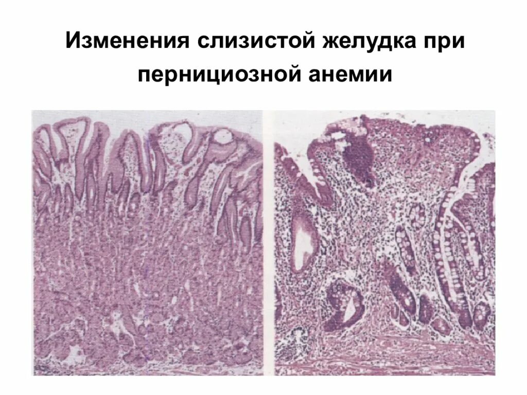 Атрофия слизистой оболочки желудка при анемии. В12-пернициозная анемия. Пернициозная анемия желудка. Атрофия слизистой оболочки желудка окраска гематоксилином.