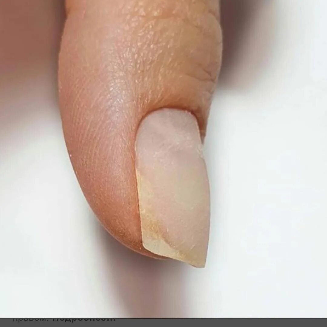 Тонкие ногти. Отслоился ноготь от гель лака что делать. Отслоился ноготь от гель лака что делать. Отслоение ногтя гель лак. Отслойка гель лака от ногтя.