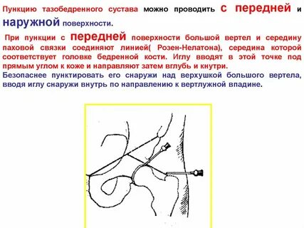 Пункция тазобедренного сустава