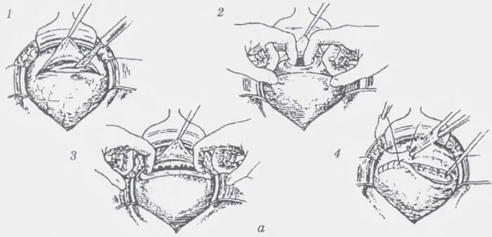 Техника кесарева. Ушивание РАН мочевого пузыря. Ушивание раны мочевого пузыря. Ушивание мочевого пузыря техника операции. Мочевой пузырь повреждение ушивание.