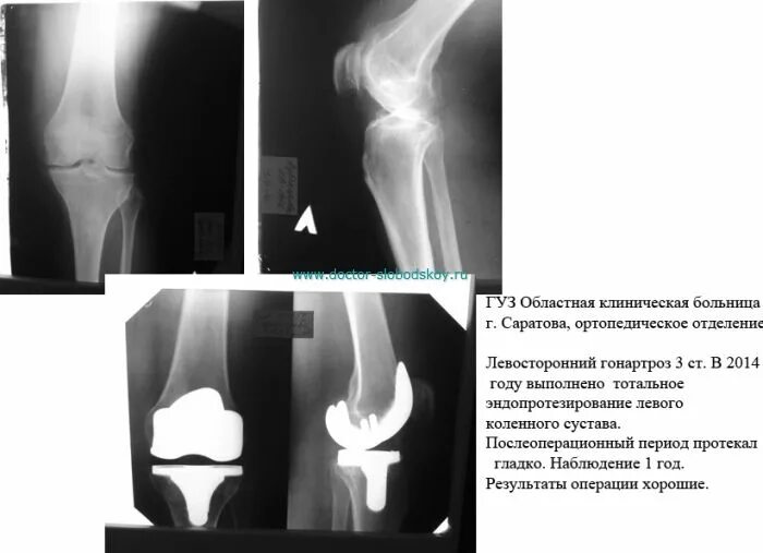 Контрактура сустава код по мкб 10. Доа коленных суставов эндопротезирование. Тотальное эндопротезирование коленного сустава рентген. Тотальный эндопротез коленного сустава рентген. Снимок коленного сустава после эндопротезирования.
