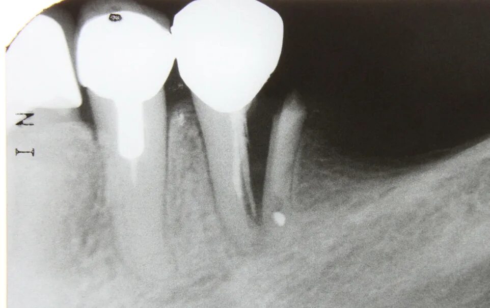 Коронково-корневой перелом зуба. Перелом корня депульпированного зуба. Продольный перелом зуба рентген. Перелом корня зуба рентген.