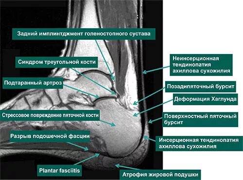 Синдромы голеностопного сустава. Суставная сумка голеностопного сустава. Жировая клетчатка Кагера голеностопного сустава. Сумки голеностопного сустава анатомия мрт. Жировое тело голеностопного сустава.