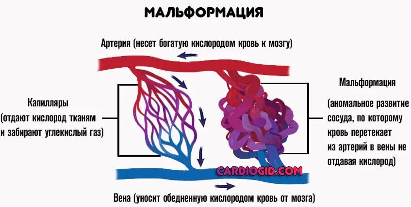 Сосудистая аномалия. Сосудистая мальформация. Артериовенозная мальформация (АВМ). Артериально венозная мальформация сосудов. Артериовенозные мальформации сосудов головного мозга.