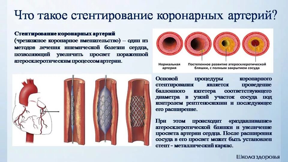 Стентирование сердца как проводится. Стентирование сосудов артерии. операция стентирование сосудов сердца. стенты для коронарных сосудов.