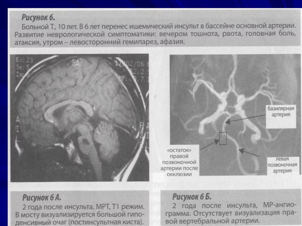 Ишемический инсульт вертебро-базилярного бассейна. Инсульт передней мозговой артерии. Инсульт в средней мозговой артерии клиника. Инсульт основной артерии ишемический.