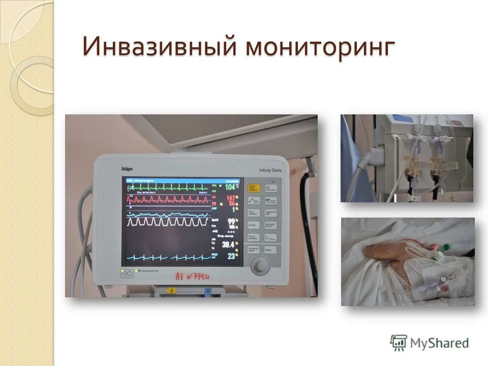 инвазивное артериальное давление методика измерения. инвазивный гемодинамический мониторинг. датчик инвазивного измерения давления. артериальный катетер для измерения инвазивного давления. прямой метод измерения ад.