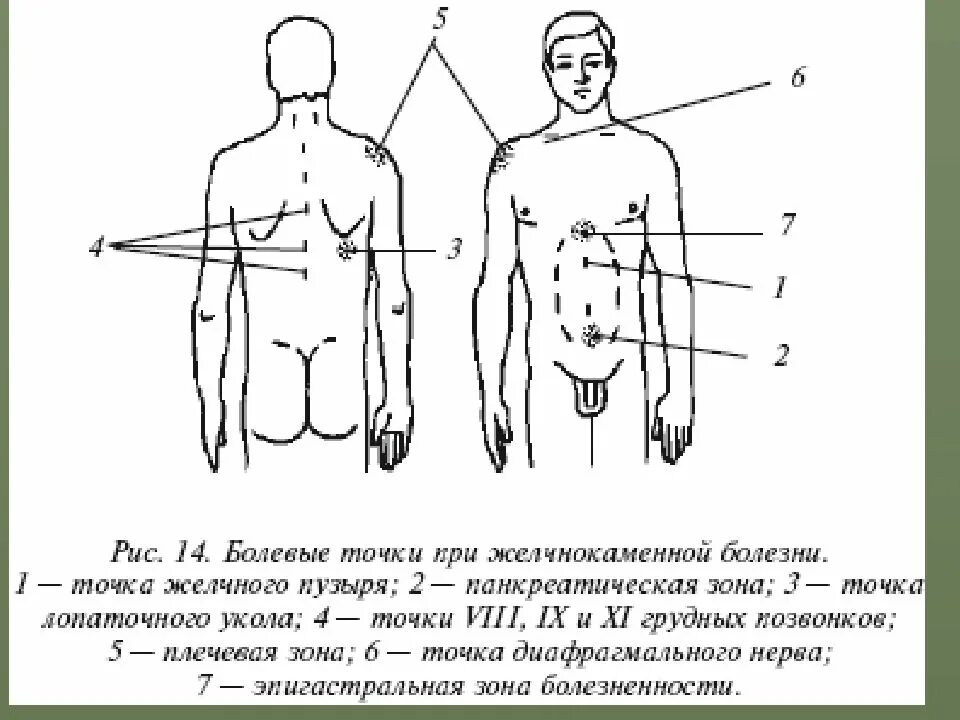 Болезненные точки при желчнокаменной болезни. Болевые точки при пальпации желчного пузыря. Болевые точки при патологии желчного пузыря. Болевые точки при поражении желчного пузыря.