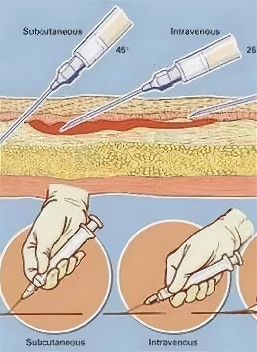 Как правильно делать укол в Вену. Как правильно колоть уколы в Вену.
