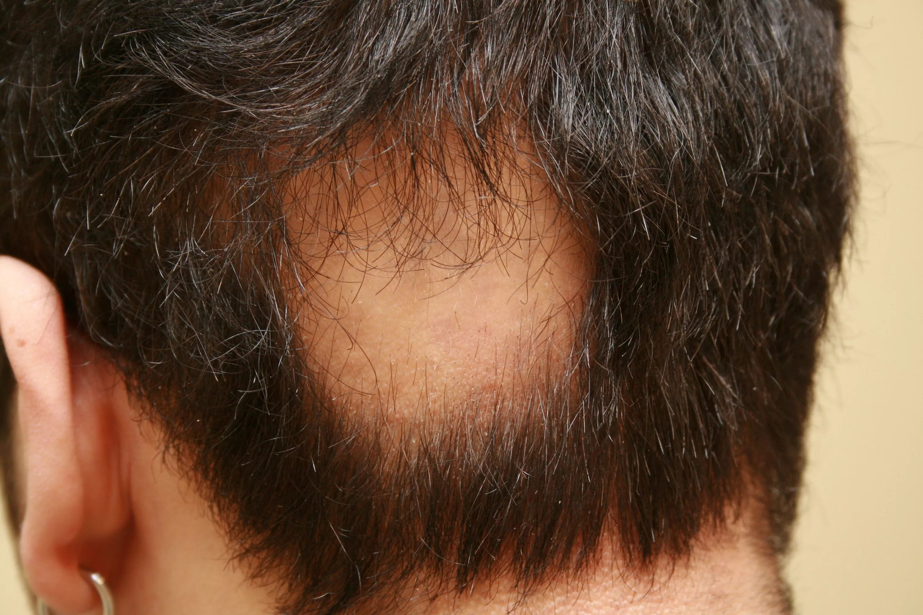 Экозависимая алопеция. Очаговая алопеция (alopecia Areata). Очаговая (гнездная) алопеция.