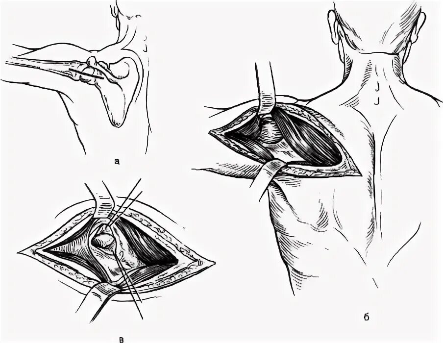 Артротомия плечевого сустава. Артротомия плечевого сустава по Лангенбеку. Передняя артротомия плечевого сустава по Лангенбеку. Артротомия плечевого сустава топографическая анатомия. Пункции, артротомия и резекция плечевого сустава..