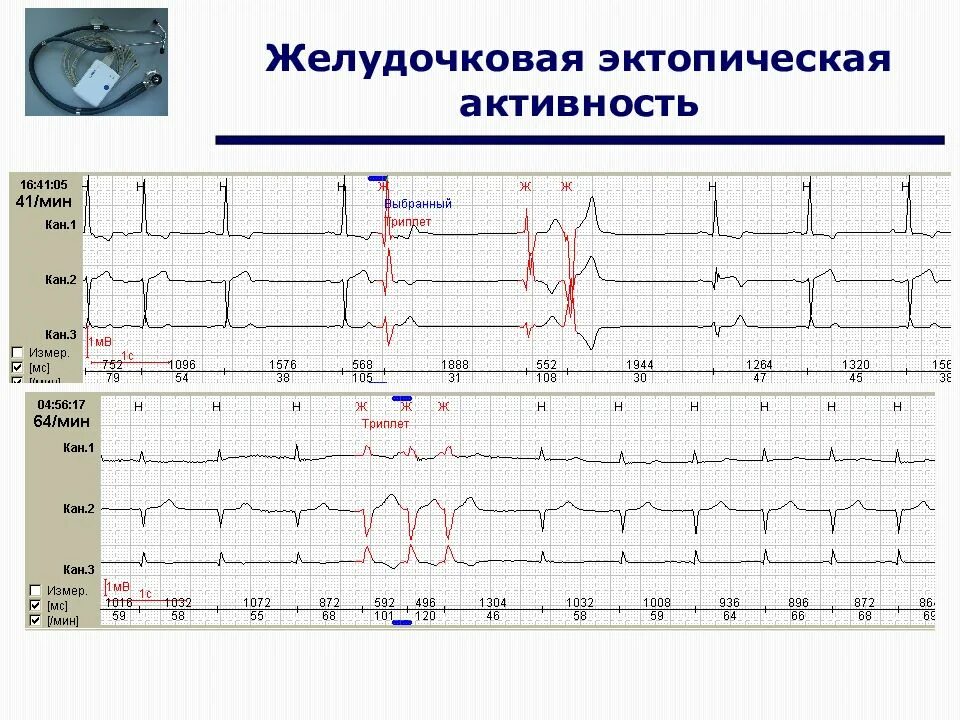 Сколько экстрасистол норма