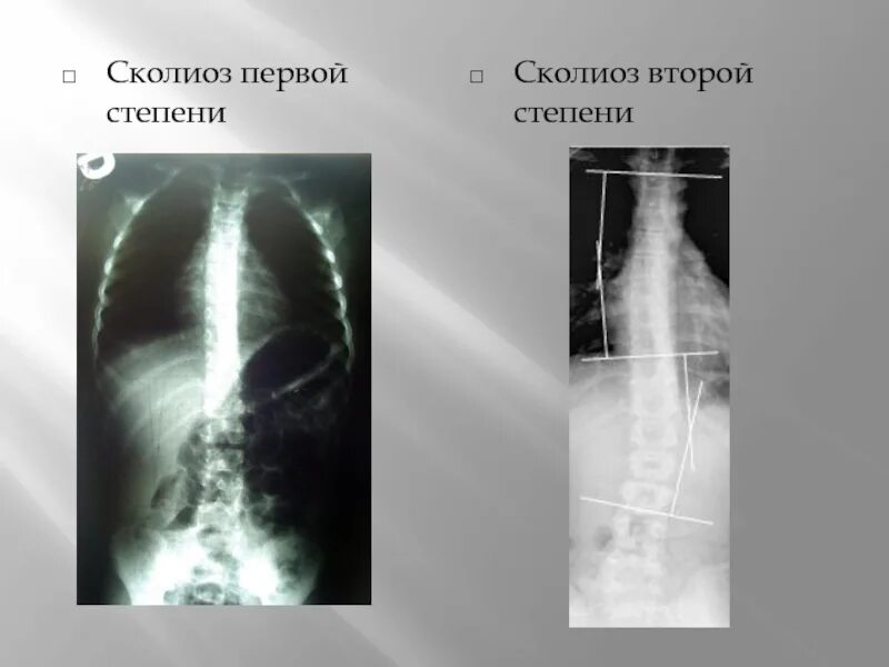 Сколиоз 4 степени рентген. Сколиоз рентген 1 степени степени. Сколиоз 1 степени рентген. Сколиоз 2 степени рентген. Сколиоз 2 степени это