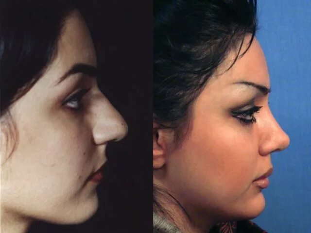 Бабич до и после ринопластики. Ринопластика. Ринопластика орлиного носа. Красивые носы после ринопластики. Нос до и после ринопластики.