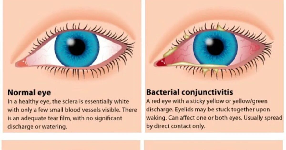 Эпидемический конъюнктивит Коха. Катаральный конъюнктивит аллергический. Бактериальный конъюнктивит, бактериальный. Возбудители конъюнктивита. Коньюктивит века