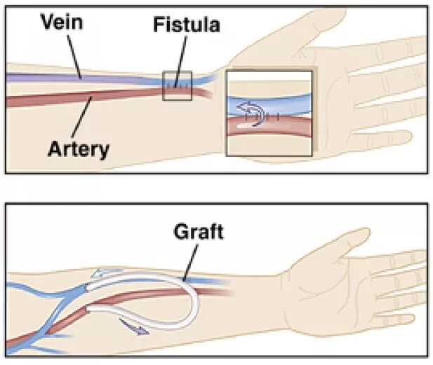 Фистула. Фистула гемодиализ схема. Фистула гемодиализ из чего состоит. Фистула гемодиализ схема подключения.