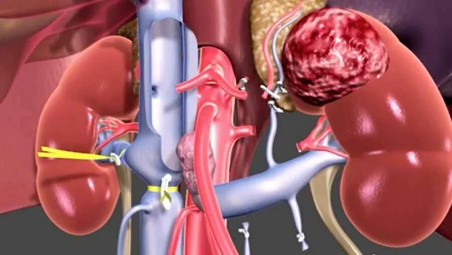 Как выглядит рак почек Intoduction to small renal tumours and prognostic indicators Tumor, Renal