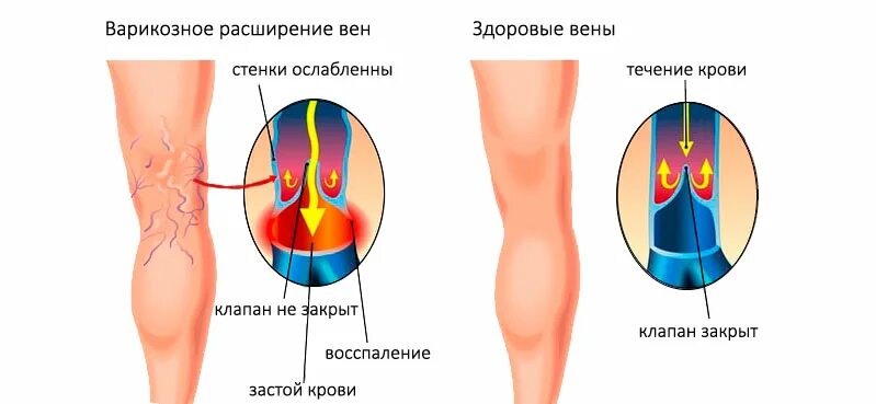 Варикозная болезнь вен нижних конечностей. Варикозное расширение вен нижних конечностей факторы. Варикозно расширенные вены ног. Боли при варикозном расширении