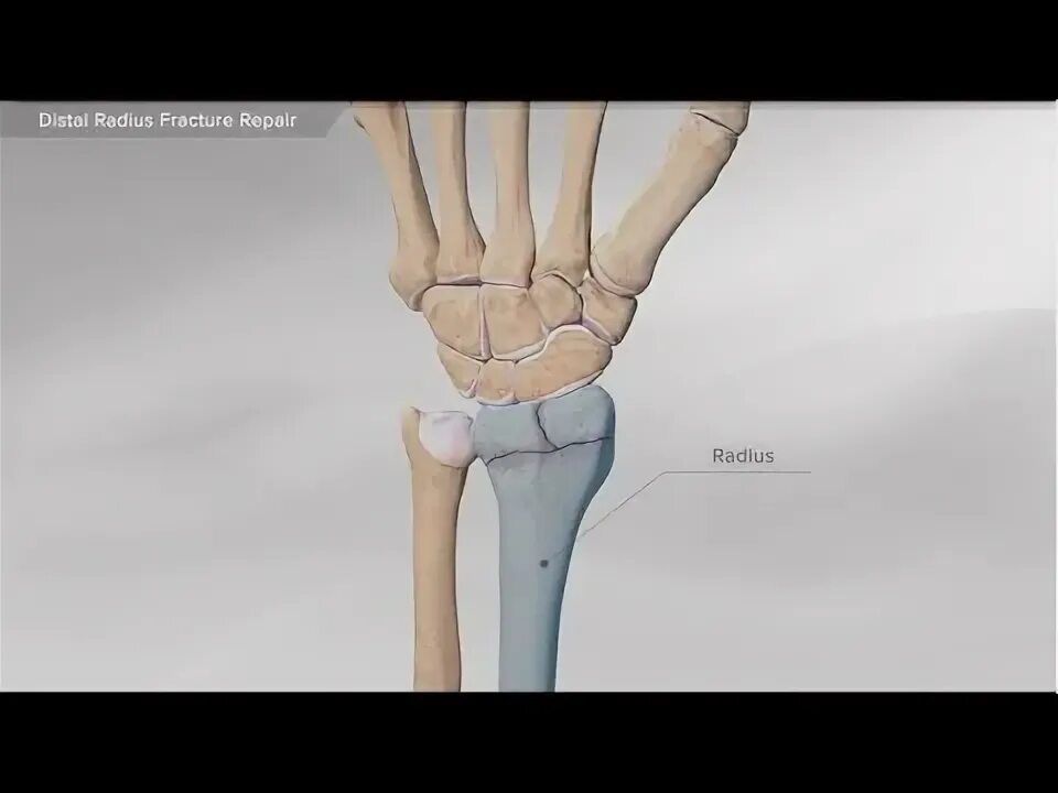 Radius fracture. Radius fracture