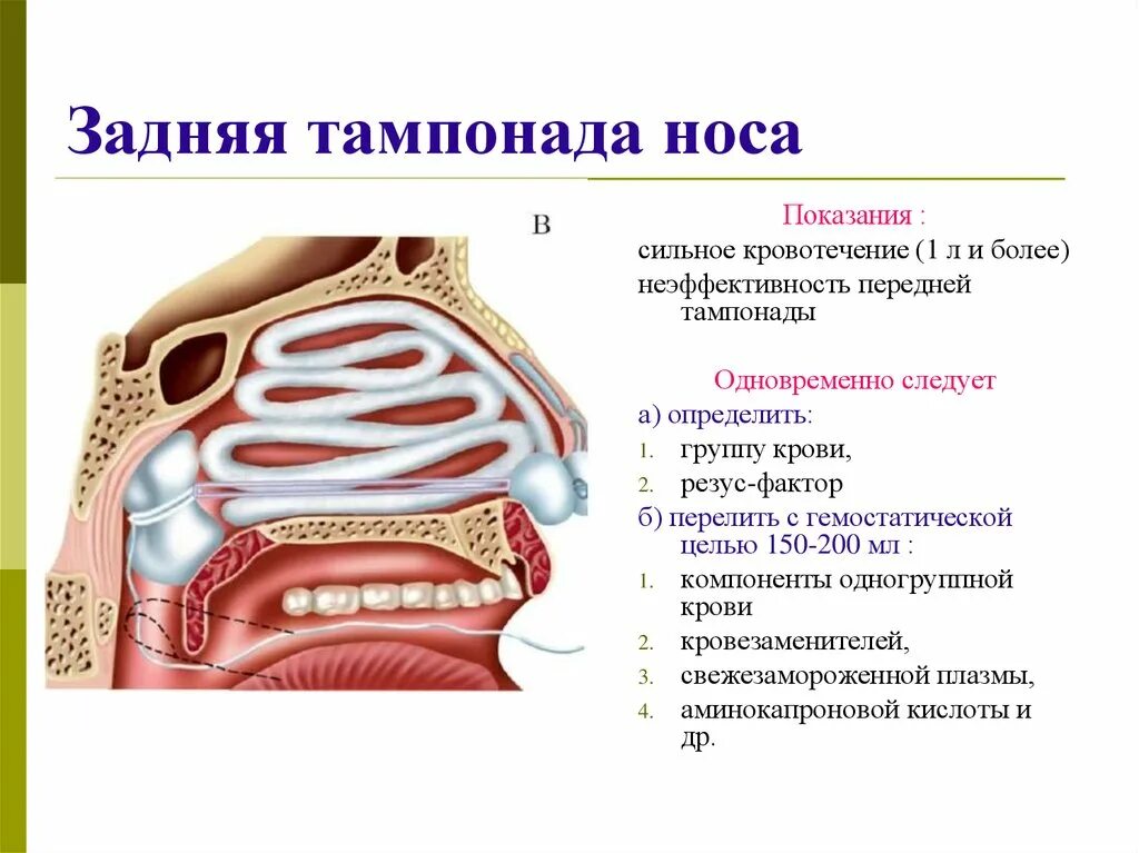 Тампонада носа при носовом кровотечении. Задняя тампонада при носовом кровотечении алгоритм. Передняя и задняя тампонада носа алгоритм. Передняя тампонада при носовом кровотечении алгоритм. Алгоритм передней тампонады носа.