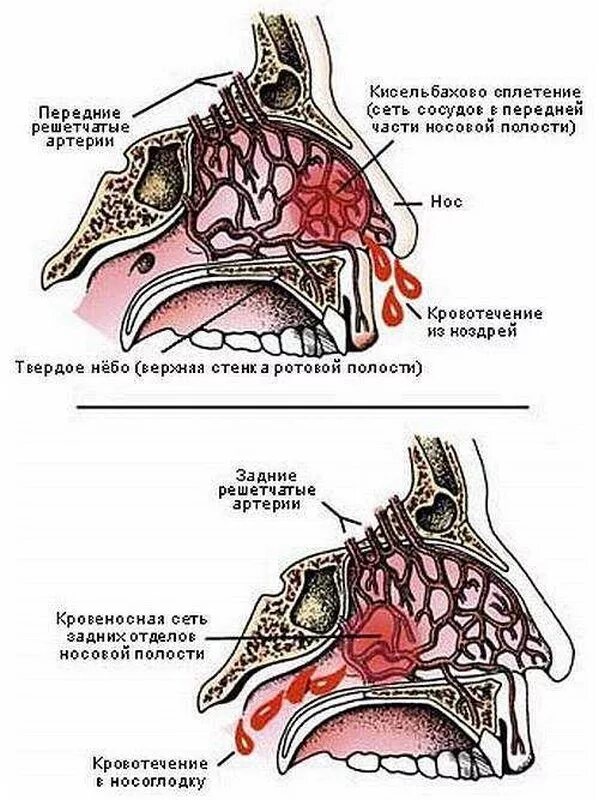 Передние и задние носовые кровотечения. Переднее и заднее носовое кровотечение. Частая кровь из носа