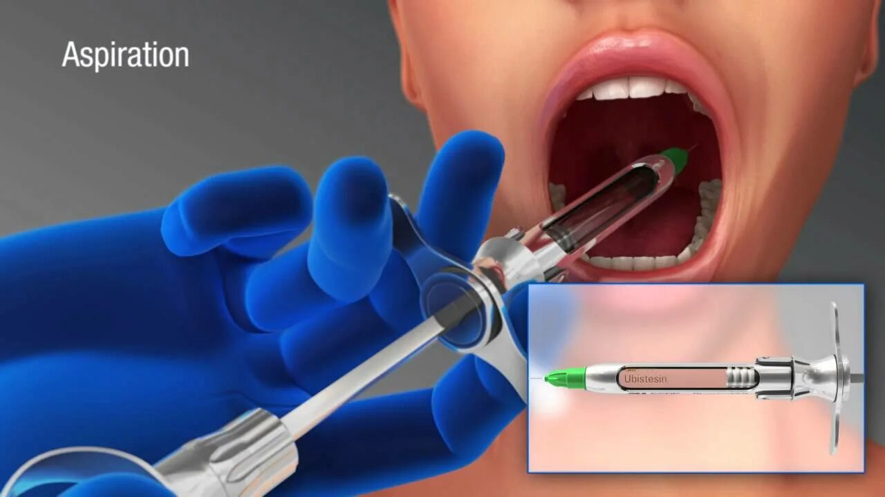 Анестезия полости рта. Карпульный шприц для аспирационной пробы. Аспирационная проба карпульным шприцом. Аспирационная проба в стоматологии карпульным шприцом. Шприц для анестезии в стоматологии.