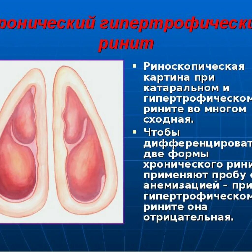 Слизистые оболочки носовых ходов. Острый катаральный ринит. Гипертрофический ринит риноскопия. Гипертрофический ринит слизистая. Острый ринит риноскопическая картина.