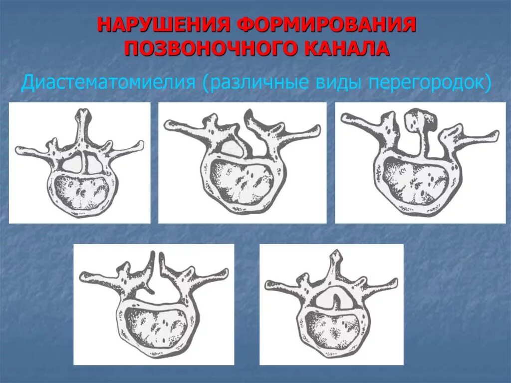 Аномалии развития поясничного отдела позвоночника. Мальформации позвонков. Пороки развития позвоночного канала.