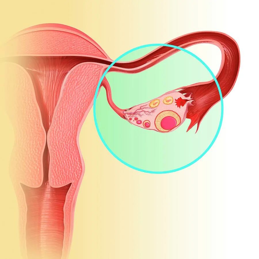 истмический нодозный сальпингит. маточные трубы при беременности. месячные и маточные трубы. месячные и маточные трубы. месячные и маточные трубы.