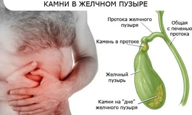 Ноет желчный пузырь. Камни в жёлчном пузыре пузыре. Камн и в желечном пузыре.