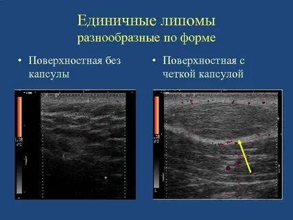 Доброкачественных новообразований подкожно жировой клетчатки