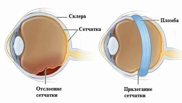 Отслоение сетчатки восстановление. Отслоение сетчатки операция. Отслоение сетчатки восстановление зрения.