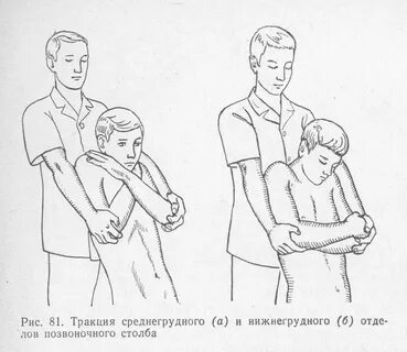 Как вставить позвонки на место