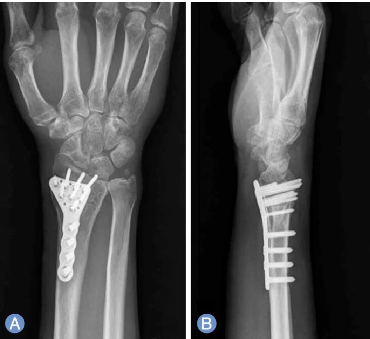 Radius fracture. Distal fracture classification.