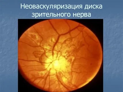 Зрительный диск